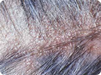 Signs and Symptoms of Dandruff